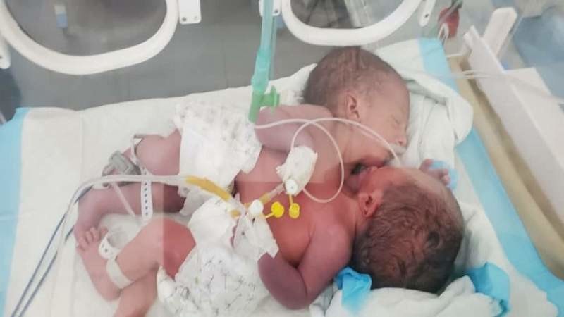 ولادة توأم سيامي ملتصق بمنطقة الصدر والبطن في عمران